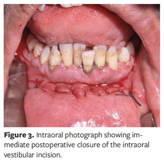 Intraoral Wound Dehiscence After Open Reduction Internal Fixation of